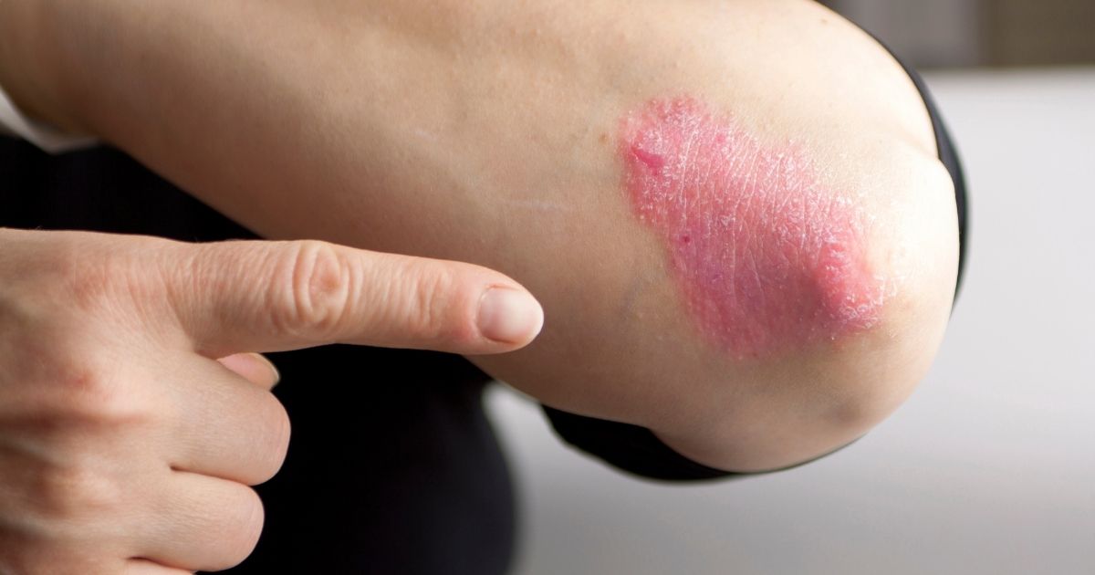 psoriasi