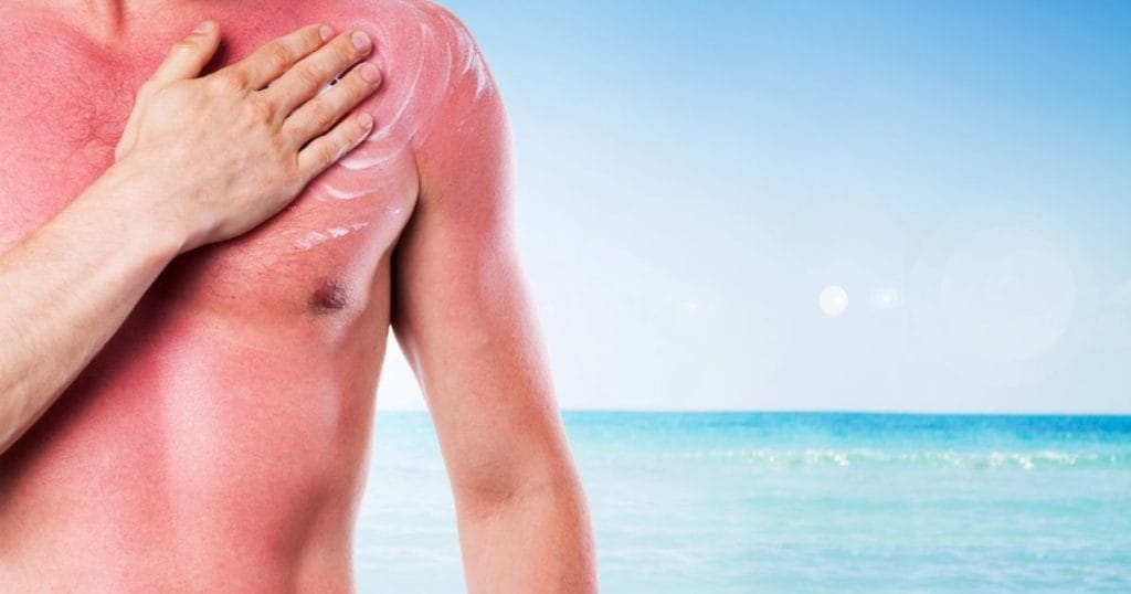 uomo con pelle scottata dal sole